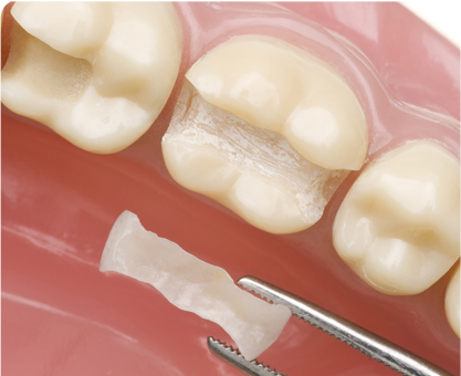 Porcelain Inlays/Onlays