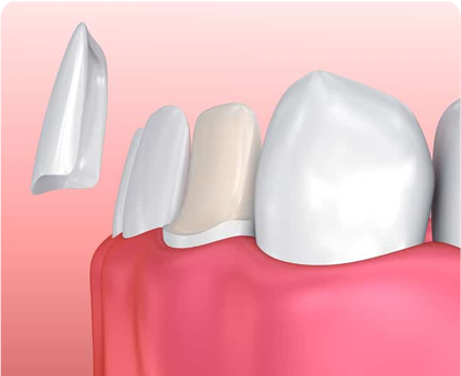 Porcelain Veneers